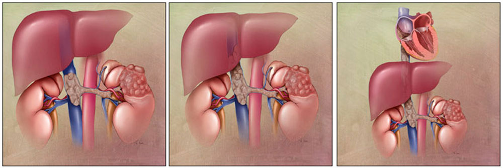 IVC thrombosis:Malignant thrombus